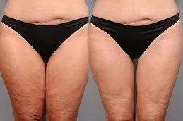 J Plasma for Thigh and Arms before & After