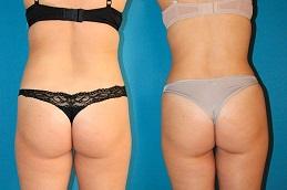 J Plasma for Thigh and Arms clinic before & After Dubai