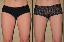J Plasma for Thigh and Arms clinic before & After