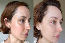 Korean Glass Skin Facial before & after Clinic Dubai