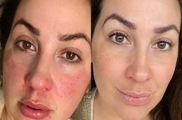 Korean Glass Skin Facial before & after Dubai