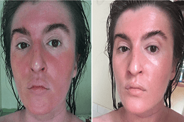 Korean Glass Skin Facial before & after in Dubai