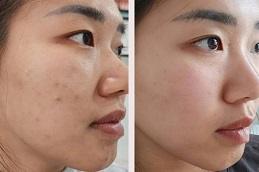 Korean Glass Skin Facial before & after