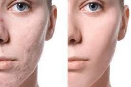 Laser Acne Scar Treatment before & After Dubai
