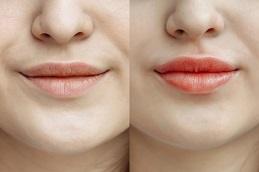 Lip Blushing Treatment before & after clinic Dubai