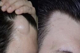 Lipoma Treatment before & After clinic in Dubai