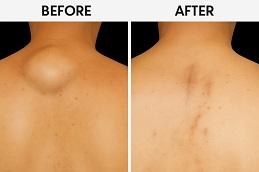 Lipoma Treatment before & After in Dubai