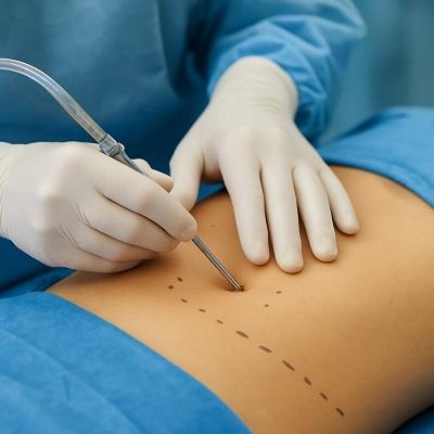 Lipomatic Treatment in Dubai & Abu Dhabi