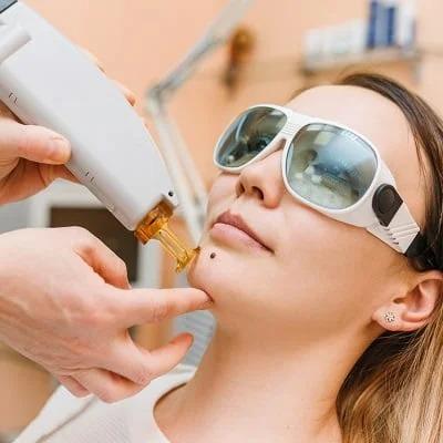 Mole Removal in Dubai & Abu Dhabi