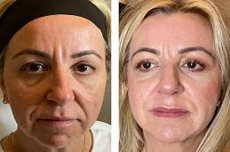 Nano Thread Lift before & After Dubai