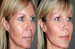 Nano Thread Lift before & After Dubai