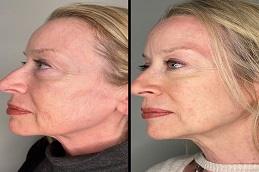 Nano Thread Lift before & After clinic in Dubai