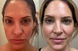 Nano Thread Lift before & After in Dubai
