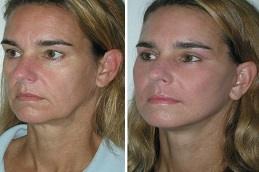 Nano Thread Lift before & After