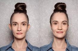 Otoplasty Ear Reshaping before & After in Dubai,