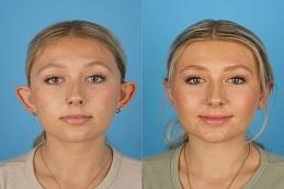 Otoplasty Ear Reshaping before & After