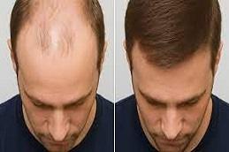 PRP Treatment For Male Pattern Baldness before & After..