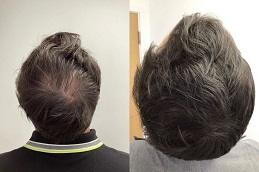 PRP Treatment For Male Pattern Baldness before & After