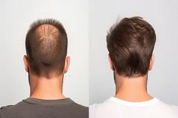 PRP Treatment For Male Pattern Baldness before & After