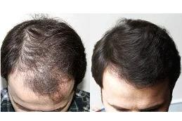 PRP Treatment for Male Pattern Baldness Dubai