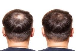 PRP Treatment for Male Pattern Baldness Dubai