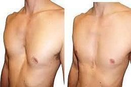 Pectoral Implants before & After Dubai & Abu Dhabi
