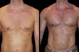Pectoral Implants before & After clinic in Dubai & Abu Dhabi