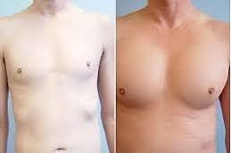 Pectoral Implants before & After in Dubai & Abu Dhabi