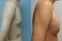 Pectoral Implants before & After in Dubai