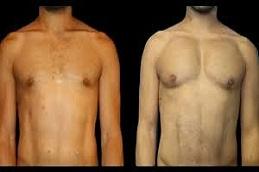 Pectoral Implants clinic before & After in Dubai