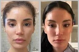 Ponytail Facelift before & after Dubai