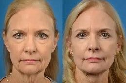 Ponytail Facelift before & after clinic Dubai