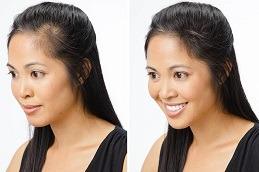 Ponytail Facelift before & after clinic in Dubai