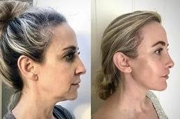 Ponytail Facelift before & after in Dubai
