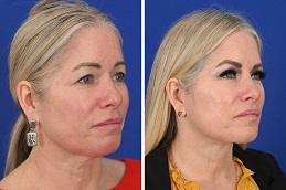 Ponytail Facelift before & after