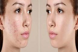 Punch Excision for Acne Scars before & After Dubai