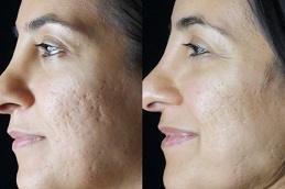 Punch Excision for Acne Scars before & After in Dubai