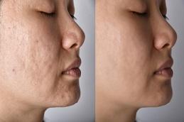 Punch Excision for Acne Scars before & After