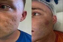 Punch Excision for Acne Scars clinic before & After Dubai