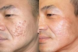 Punch Excision for Acne Scars clinic before & After