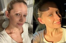 Red Carpet Facial before & after Dubai.