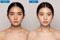 Red Carpet Facial before & after Dubai