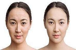 Red Carpet Facial before & after in Dubai