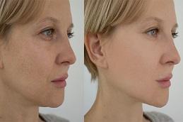 Red Carpet Facial before & after