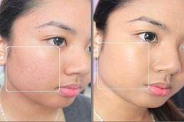 Rejuran Injection before & After in Dubai