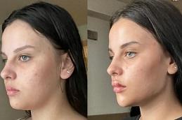 Rejuran Injection before & After