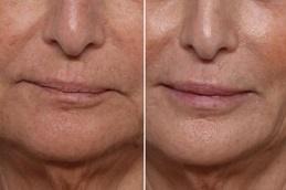 Results of Actinic Keratosis Treatment Dubai & Abu Dhabi