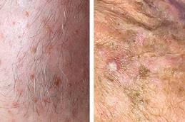 Results of Actinic Keratosis Treatment Dubai