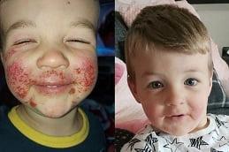 Results of Baby Skin Facial Dubai