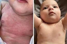Results of Baby Skin Facial clinic Dubai